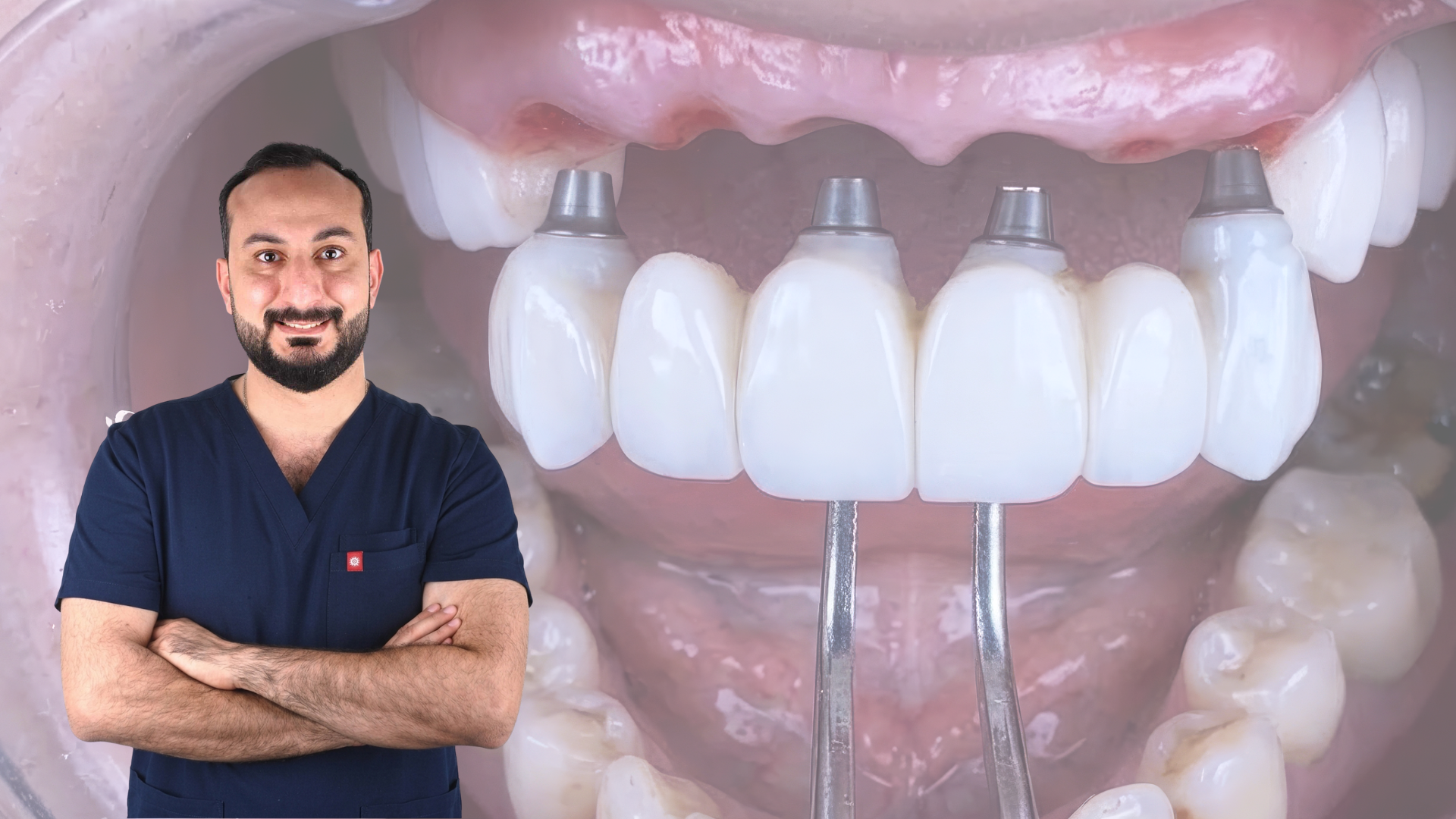 Full Arch Masterpiece - FP1 protocol