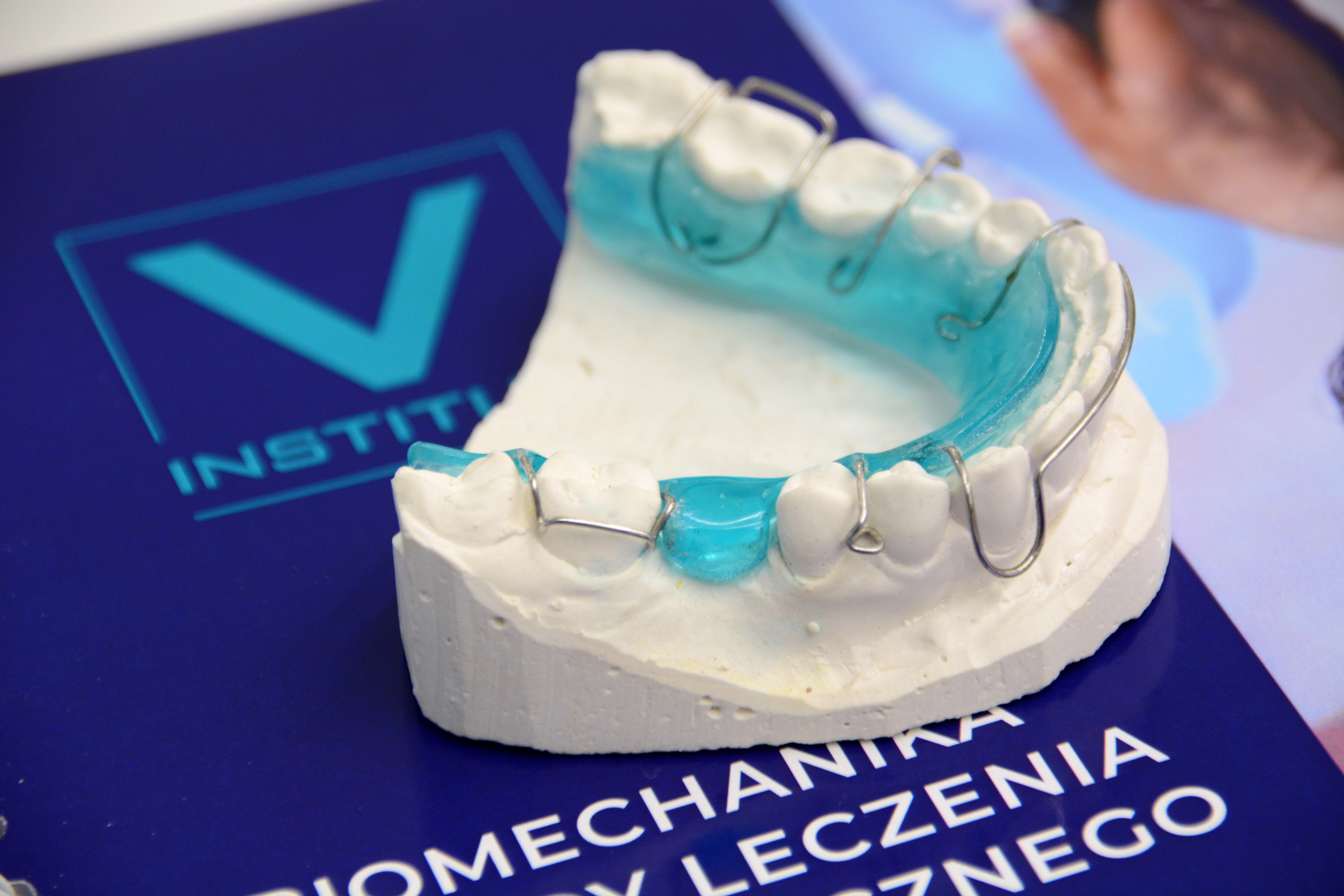 Od kanału do korony. Kompleksowe odbudowy pośrednie zębów po endodoncji - onlay, overlay